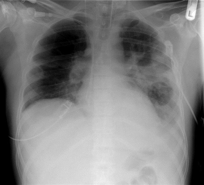 staph pneumonia chest x ray findings