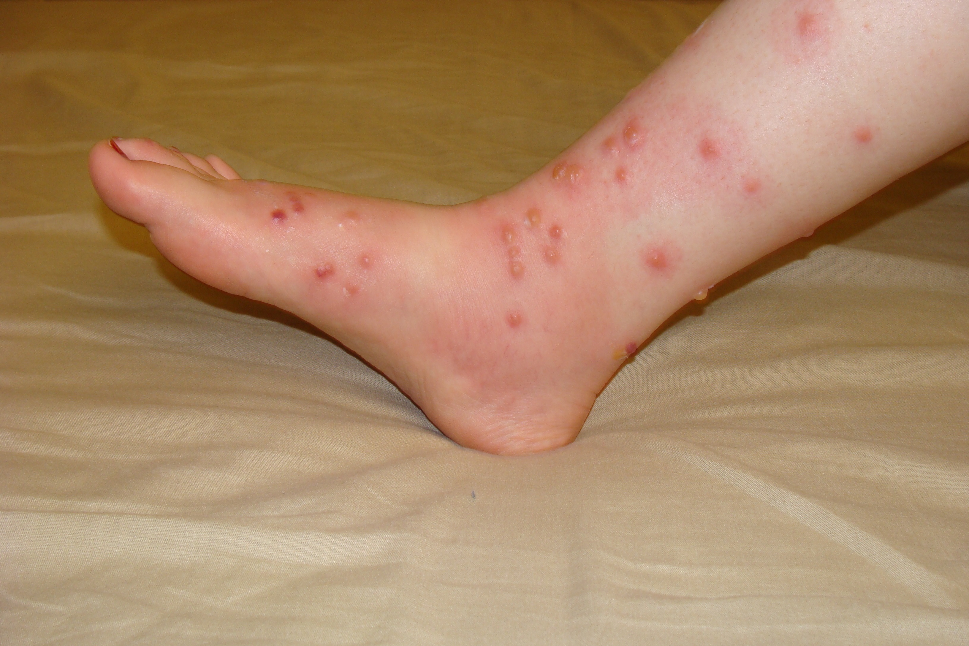 Poison ivy - oak - sumac rash: MedlinePlus Medical ...