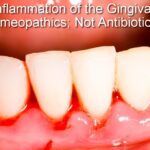 What's a “Gingiva” and How Does It Get “Itis”?