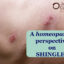 Homeopathic Perspective on Shingles EDITED