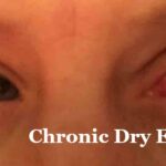 The Eyes Have It: Chronic Dry Eyes