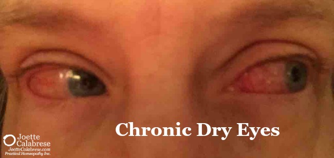 Chronic dry eye Before