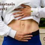 Diastasis Recti: Separation of the Abdominal Wall Muscles