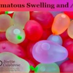 Edematous Swelling and Apis