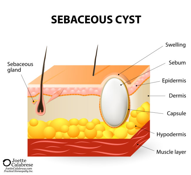 Joette Calabrese, Practical Homeopathy Annoying Sebaceous Cysts