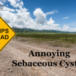 Annoying Sebaceous Cysts? Consider Powerful — Yet Polite — Practical Homeopathy®