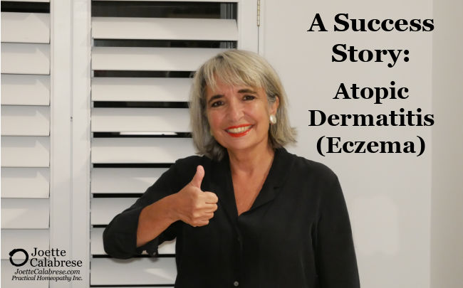 Joette Calabrese, Practical Homeopathy, A Success Story: Atopic Dermatitis (Eczema)