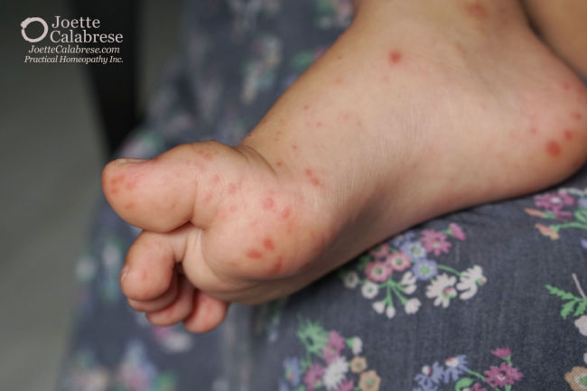 Joette Calabrese, Hand, Foot and Mouth Disease: Soften the Symptoms With Practical Homeopathy®