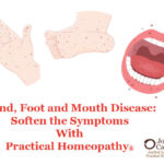 Hand Foot and Mouth Disease: Soften the Symptoms With Practical Homeopathy®