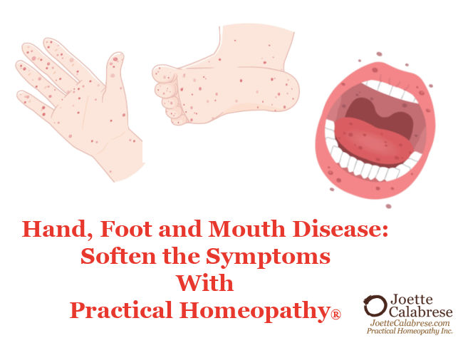 Joette Calabrese, Hand, Foot and Mouth Disease: Soften the Symptoms With Practical Homeopathy®