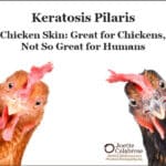 Queratosis pilaris: la piel de pollo es buena para los pollos, pero no tanto para los humanos
