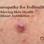 Practical Homeopathy® for Folliculitis: Achieving Skin Health Without Antibiotics