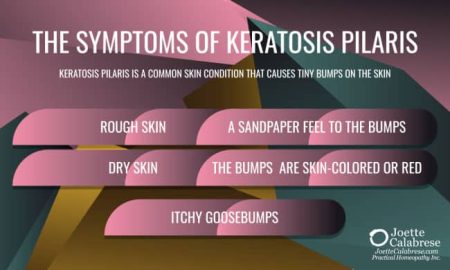 Joette Calabrese, Homeopatía Práctica®, Queratosis Pilaris: La piel de pollo es buena para los pollos, pero no tanto para los humanos