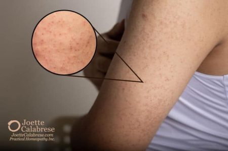 Joette Calabrese, Homeopatía Práctica®, Queratosis Pilaris: La piel de pollo es buena para los pollos, pero no tanto para los humanos