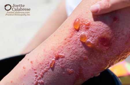 Joette Calabrese, Practical Homeopathy®, 10. Ivy venenosa: cómo antídoto antídoto toxinas venenosas con series de homeopatía
